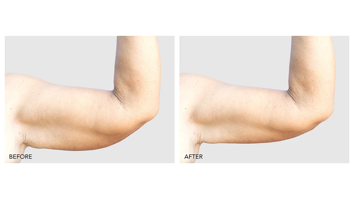 microcurrent body sculpting before and after BEAR 2 body effects on saggy uper arms